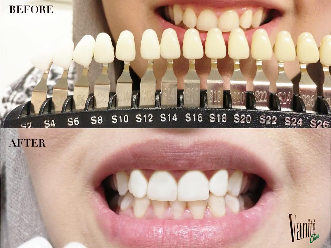 Vanite Clinic – 20% Discount on Laser Teeth Whitening